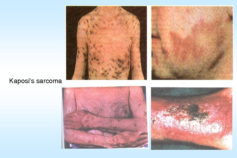 Kaposi's sarcoma 