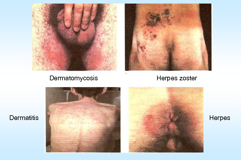Dermatomycosis Dermatitis Herpes zoster Herpes 