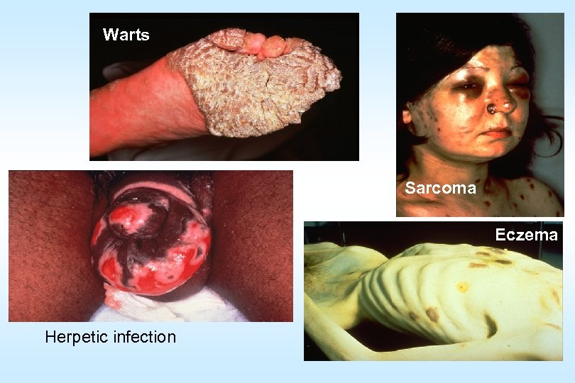 Warts Sarcoma Еczema Herpetic infection 