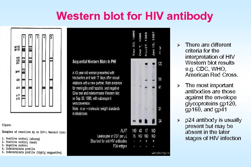 Western blot for HIV antibody Ø There are different criteria for the interpretation of