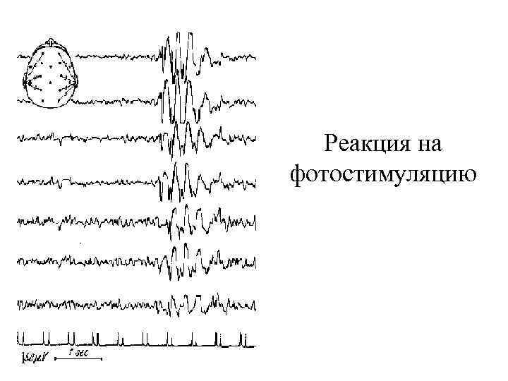 Реакция на фотостимуляцию 