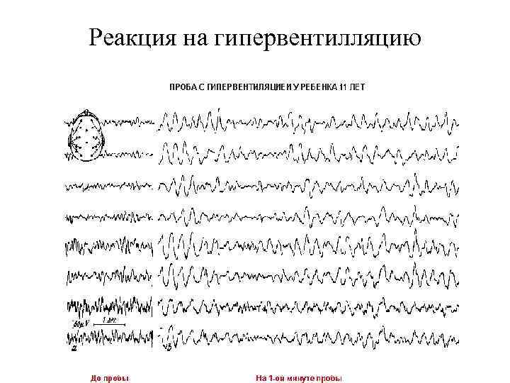 Реакция на гипервентилляцию 