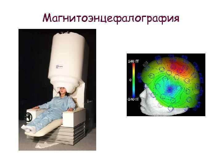 Магнитоэнцефалография 