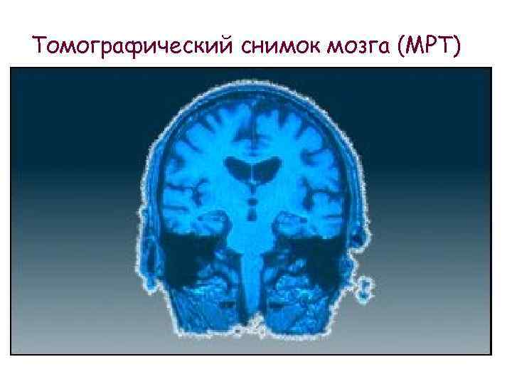 Томографический снимок мозга (МРТ) 
