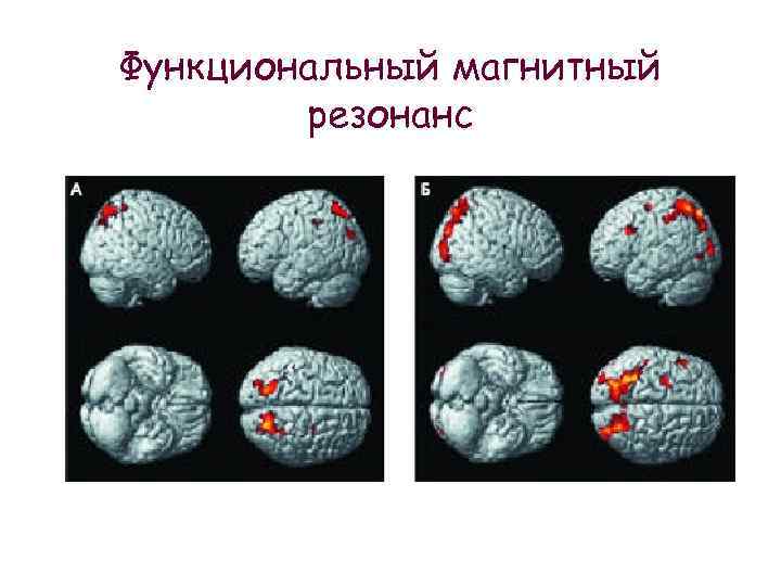 Функциональный магнитный резонанс 