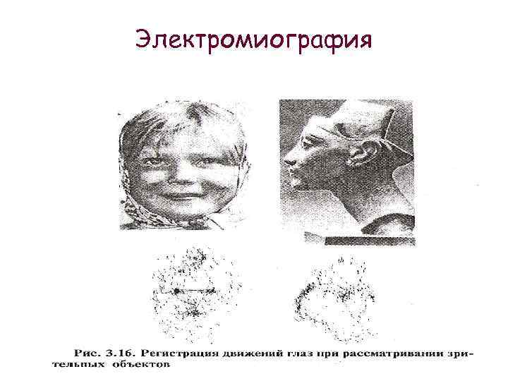 Электромиография 