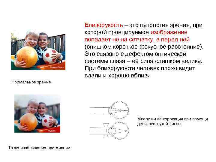 Близорукость – это патология зрения, при которой проецируемое изображение попадает не на сетчатку, а