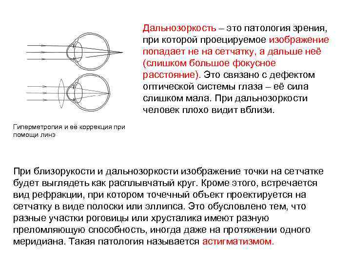 Где возникает четкое изображение на сетчатке при дальнозоркости