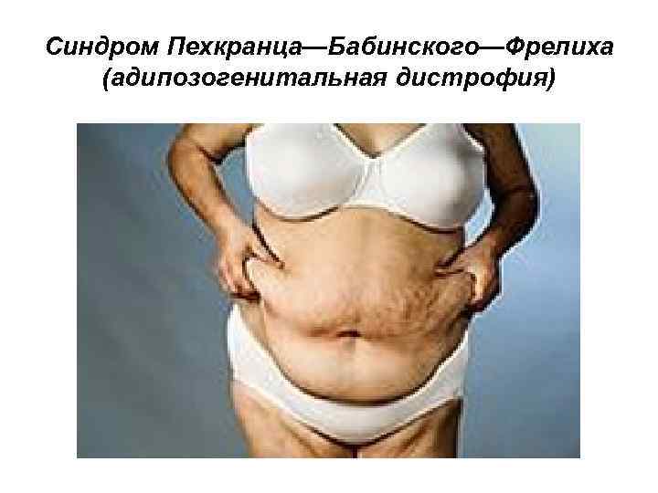 Синдром Пехкранца—Бабинского—Фрелиха (адипозогенитальная дистрофия) 