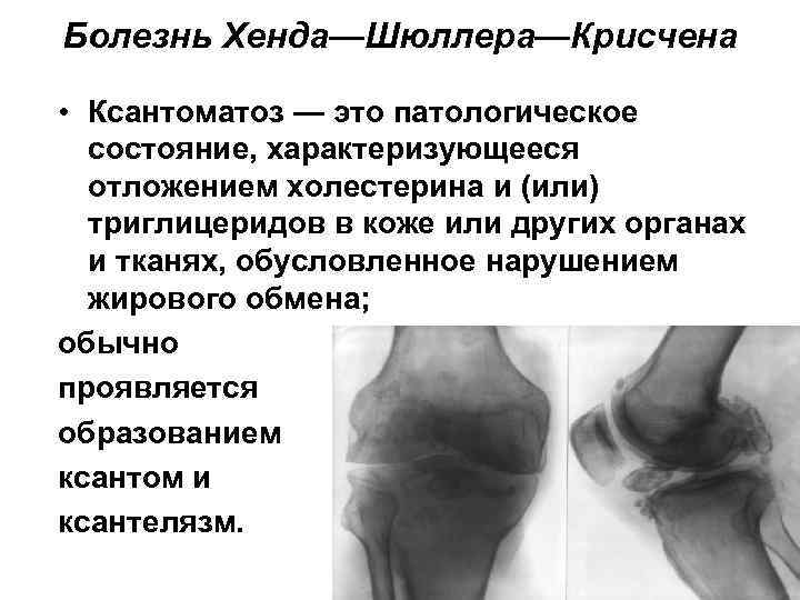 Болезнь Хенда—Шюллера—Крисчена • Ксантоматоз — это патологическое состояние, характеризующееся отложением холестерина и (или) триглицеридов