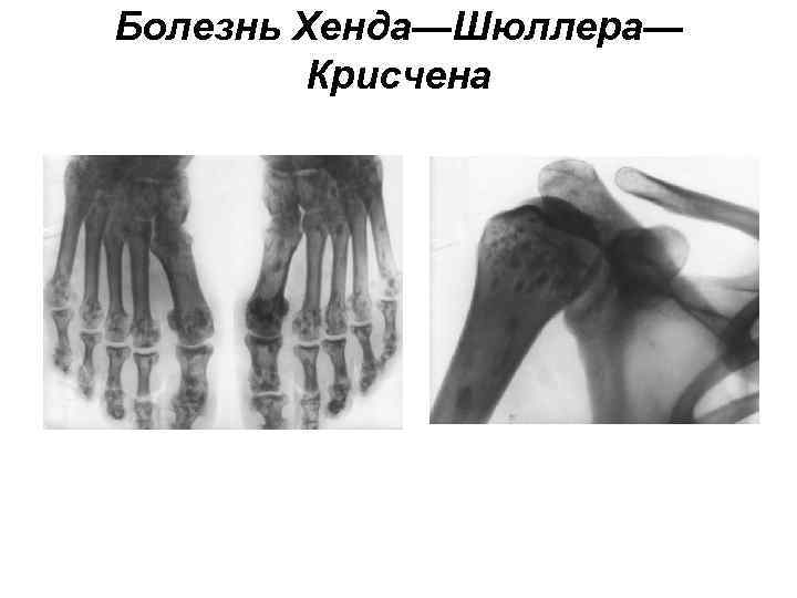 Болезнь Хенда—Шюллера— Крисчена 