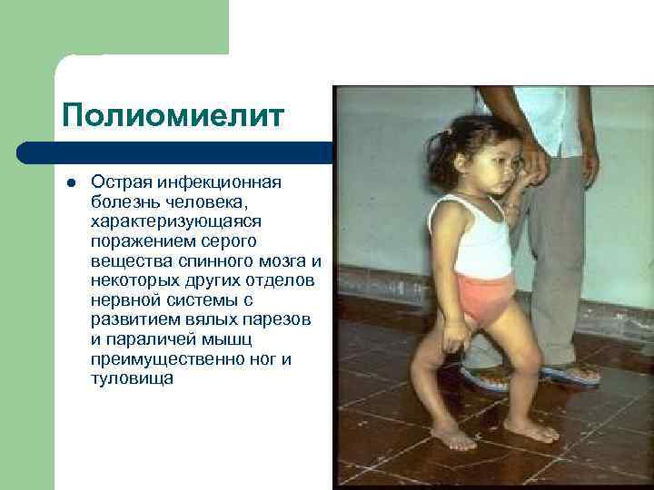 Полиомиелит l Острая инфекционная болезнь человека, характеризующаяся поражением серого вещества спинного мозга и некоторых