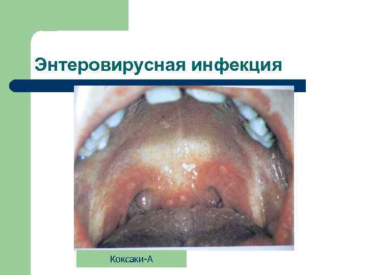 Энтеровирусная инфекция Коксаки-А 