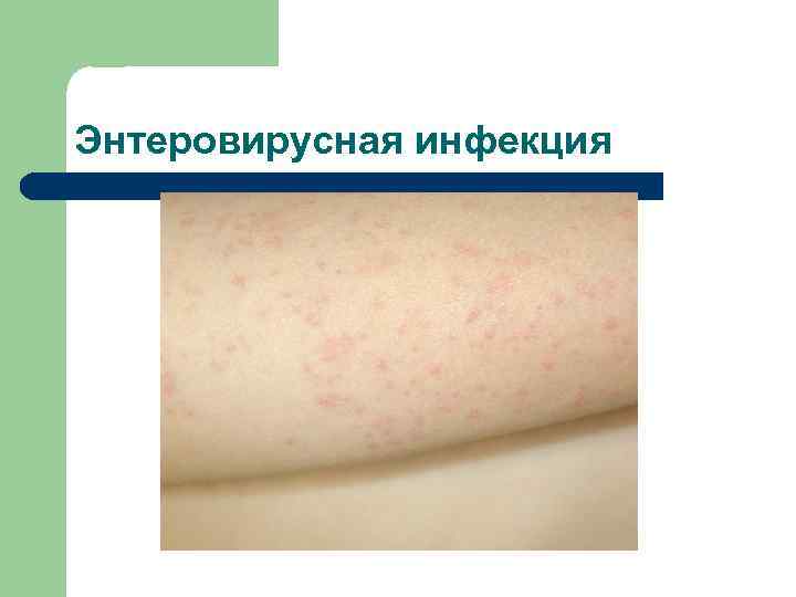 Энтеровирусная инфекция 