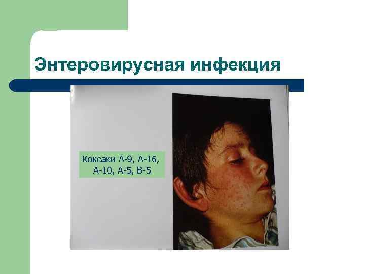 Энтеровирусная инфекция Коксаки А-9, А-16, А-10, А-5, В-5 