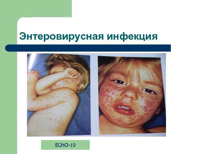 Энтеровирусная инфекция ECHO-19 