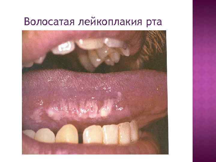 Волосатая лейкоплакия рта 