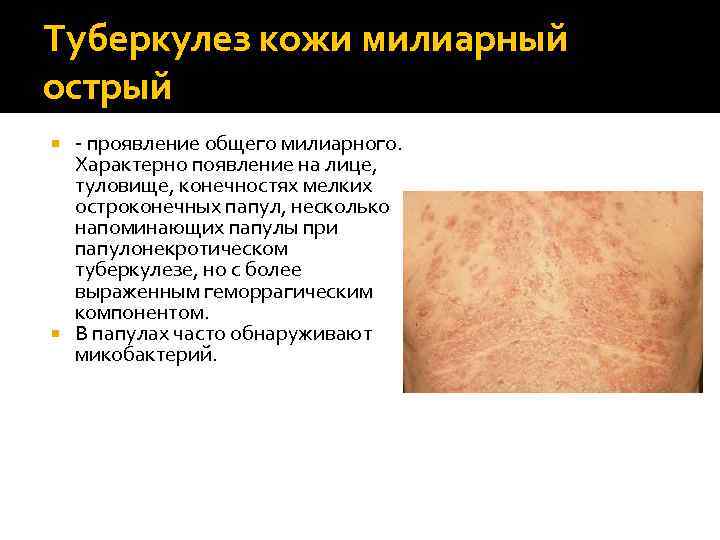 Туберкулез кожи милиарный острый - проявление общего милиарного. Характерно появление на лице, туловище, конечностях