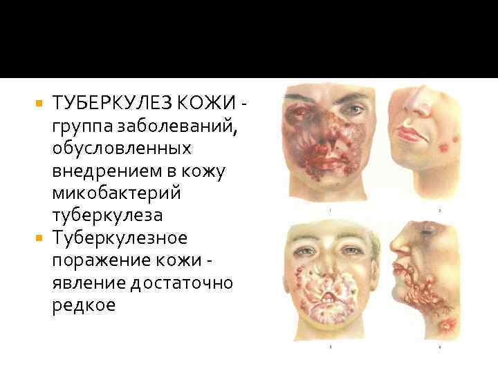 ТУБЕРКУЛЕЗ КОЖИ - группа заболеваний, обусловленных внедрением в кожу микобактерий туберкулеза Туберкулезное поражение кожи