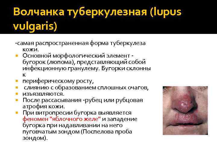 Волчанка туберкулезная (lupus vulgaris) -самая распространенная форма туберкулеза кожи. Основной морфологический элемент - бугорок