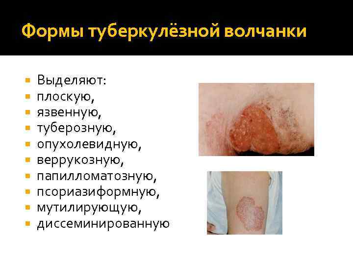 Формы туберкулёзной волчанки Выделяют: плоскую, язвенную, туберозную, опухолевидную, веррукозную, папилломатозную, псориазиформную, мутилирующую, диссеминированную 