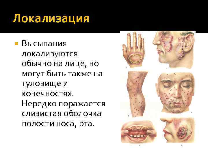 Локализация Высыпания локализуются обычно на лице, но могут быть также на туловище и конечностях.