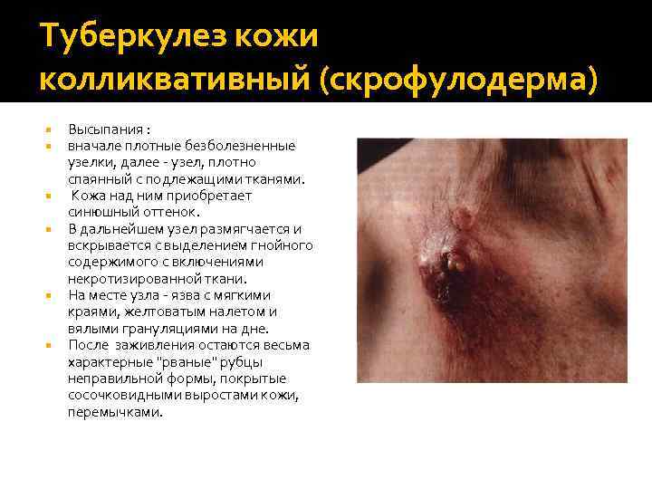 Туберкулез кожи колликвативный (скрофулодерма) Высыпания : вначале плотные безболезненные узелки, далее - узел, плотно