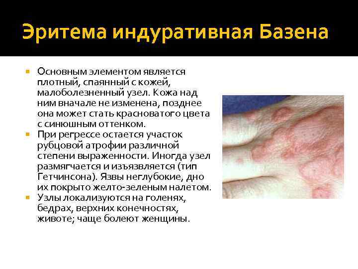 Эритема индуративная Базена Основным элементом является плотный, спаянный с кожей, малоболезненный узел. Кожа над