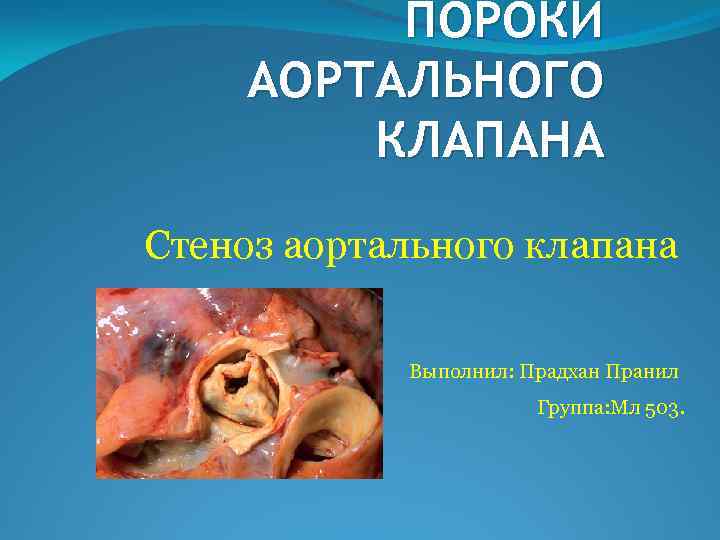 ПОРОКИ АОРТАЛЬНОГО КЛАПАНА Стеноз аортального клапана Выполнил: Прадхан Пранил Группа: Мл 503. 