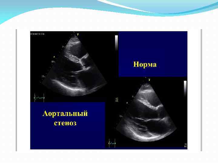 Стеноз аортального клапана