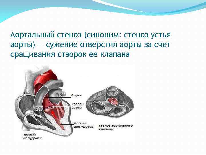 Аортальный стеноз (синоним: стеноз устья аорты) — сужение отверстия аорты за счет сращивания створок