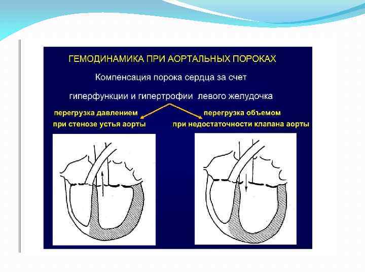 Пороки аортального клапана презентация