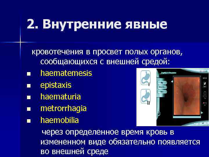 2. Внутренние явные кровотечения в просвет полых органов, сообщающихся с внешней средой: n haematemesis