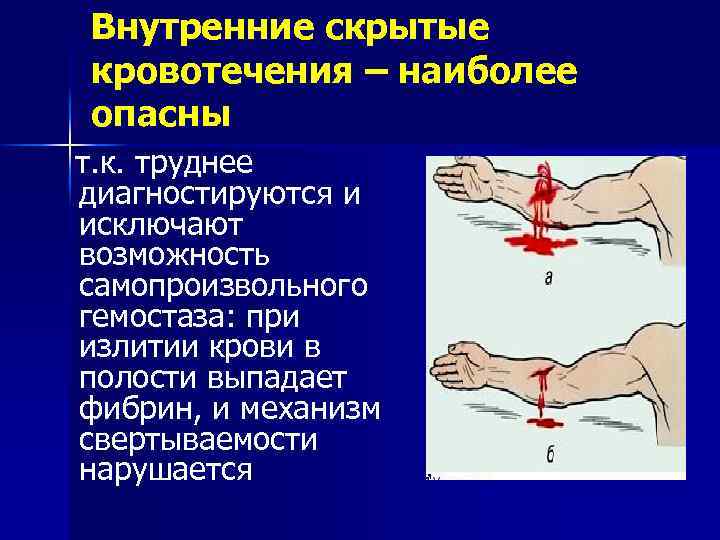 Внутренние скрытые кровотечения – наиболее опасны т. к. труднее диагностируются и исключают возможность самопроизвольного