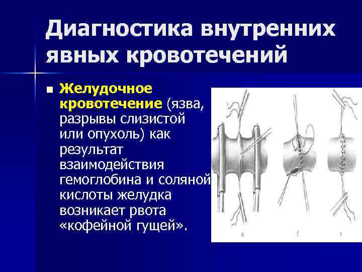 Диагностика внутренних явных кровотечений n Желудочное кровотечение (язва, разрывы слизистой или опухоль) как результат