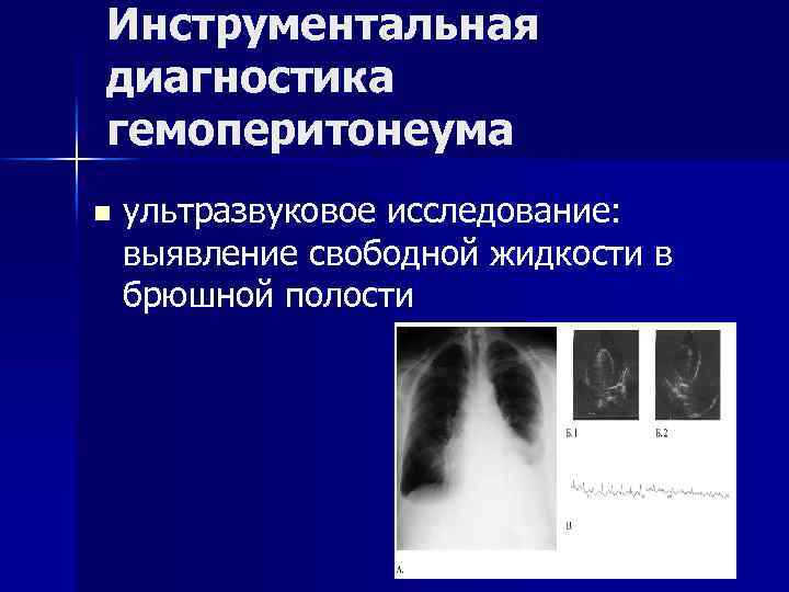 Инструментальная диагностика гемоперитонеума n ультразвуковое исследование: выявление свободной жидкости в брюшной полости 