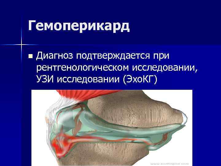 Гемоперикард n Диагноз подтверждается при рентгенологическом исследовании, УЗИ исследовании (Эхо. КГ) 