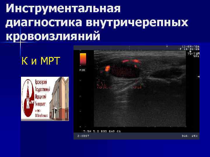 Инструментальная диагностика внутричерепных кровоизлияний К и МРТ 