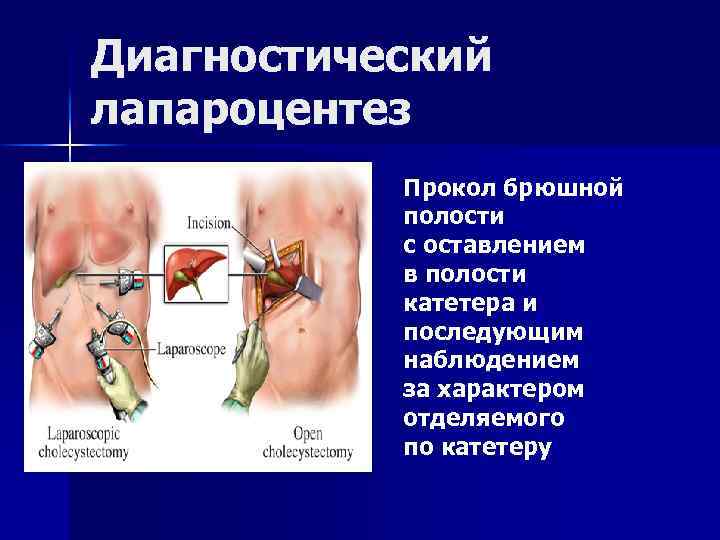 Диагностический лапароцентез Прокол брюшной полости с оставлением в полости катетера и последующим наблюдением за