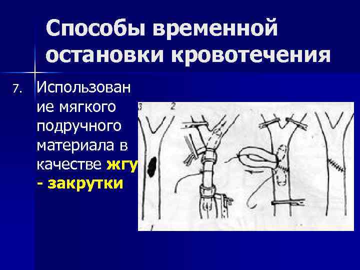 Способы временной остановки кровотечения 7. Использован ие мягкого подручного материала в качестве жгута -