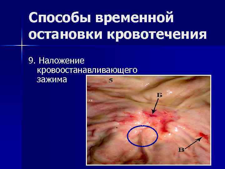 Способы временной остановки кровотечения 9. Наложение кровоостанавливающего зажима 