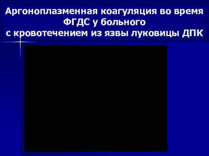 Аргоноплазменная коагуляция во время ФГДС у больного с кровотечением из язвы луковицы ДПК 