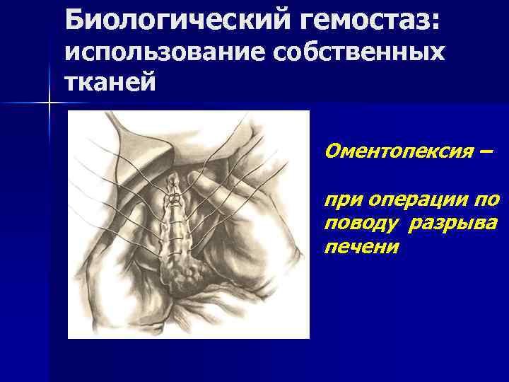 Биологический гемостаз: использование собственных тканей Оментопексия – при операции по поводу разрыва печени 