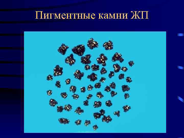 Пигментные камни ЖП 