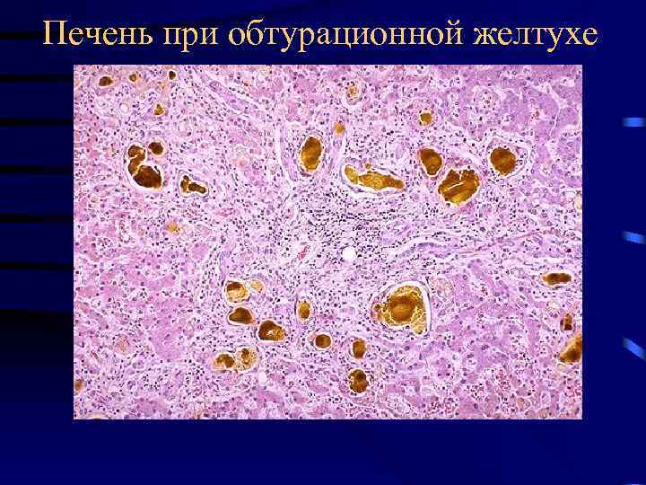 Печень при обтурационной желтухе 