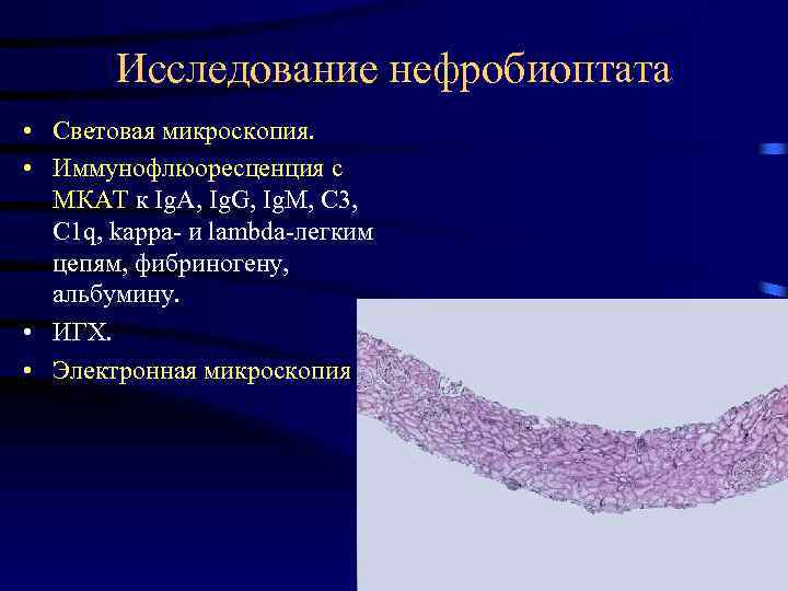 Исследование нефробиоптата • Световая микроскопия. • Иммунофлюоресценция с МКАТ к Ig. A, Ig. G,