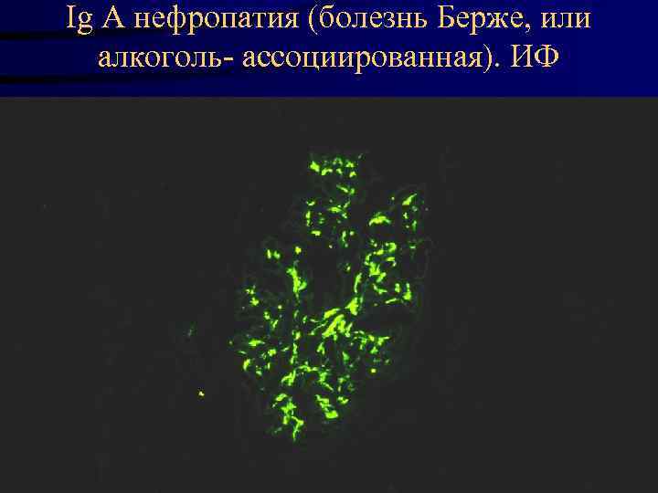 Ig A нефропатия (болезнь Берже, или алкоголь- ассоциированная). ИФ 