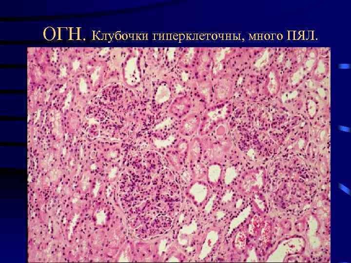 ОГН. Клубочки гиперклеточны, много ПЯЛ. 