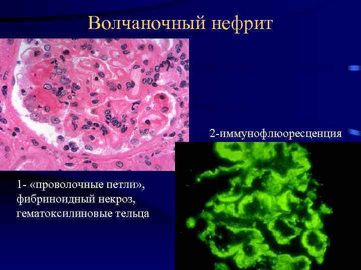 Волчаночный нефрит 2 -иммунофлюоресценция 1 - «проволочные петли» , фибриноидный некроз, гематоксилиновые тельца 