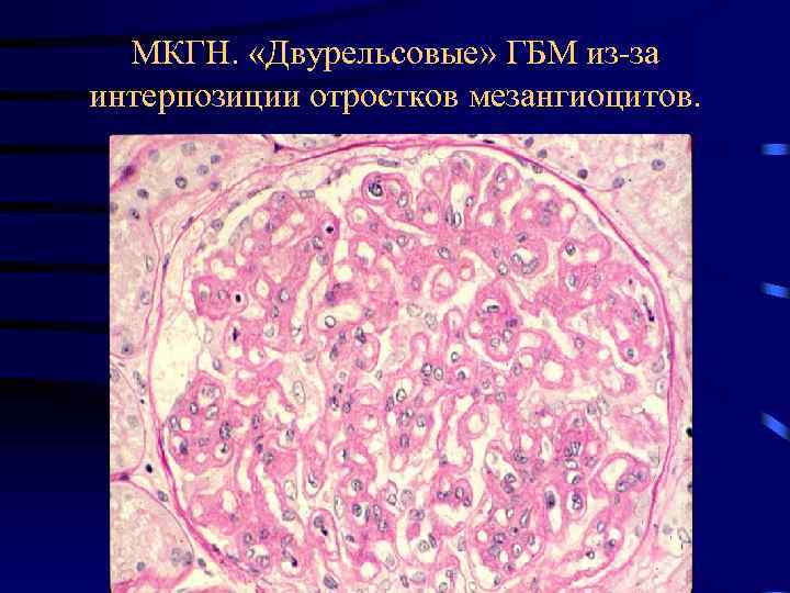 МКГН. «Двурельсовые» ГБМ из-за интерпозиции отростков мезангиоцитов. 